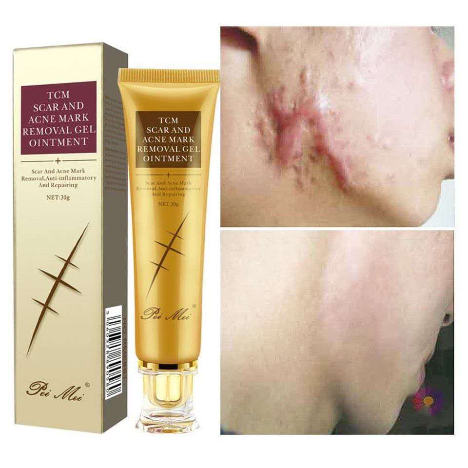 TCM Scar Acne Mark Removal Gel Ointment, 30g